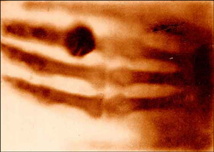 Roentgen Discovers X-Rays image